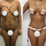 Lipectomía, Liposucción, Pexia Mamaria con implante y Lipotransferencia Glútea