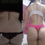 Liposucción 360° y Lipotransferencia Glútea