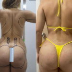 Liposucción 360° y Lipotransferencia Glútea