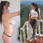 Liposucción, Lipectomía y Pexia Mamaria