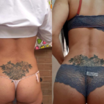 Liposucción 360° y Lipotransferencia Glútea